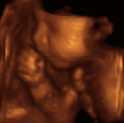 3d-ultrasound-image 3d-ultrasound-image